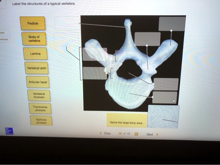 Label the structures of a typical vertebra