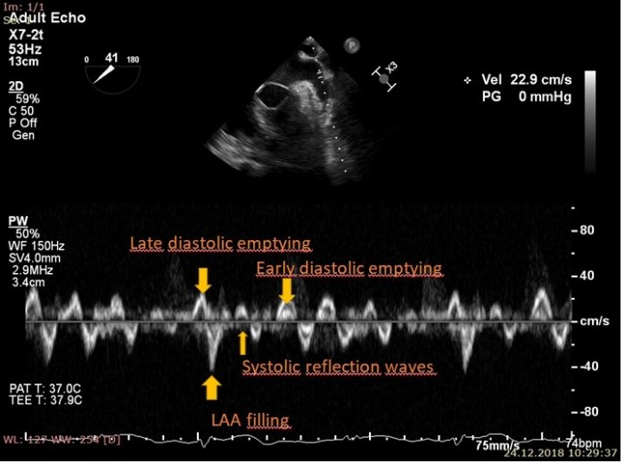 Hepatic artery pump transplant arterial tubes resistance ref flow normal low waveform liver