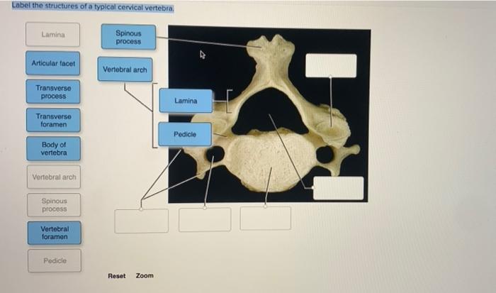 Label the structures of a typical vertebra