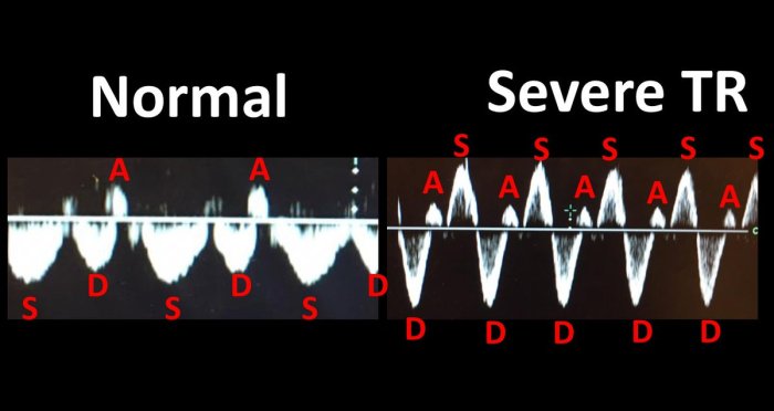 Hepatic vein flow reversal severe tr