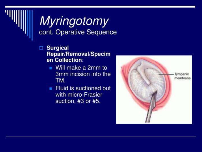 Myringotomy with tube insertion cpt code