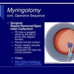 Myringotomy with tube insertion cpt code