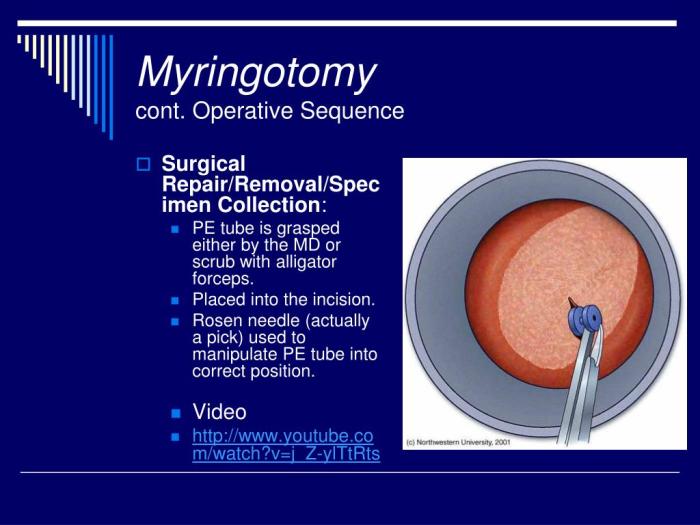 Myringotomy with tube insertion cpt code