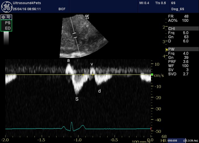 Quiz echocardiography answer block complete heart diastolic regurgitation tricuspid figure journal